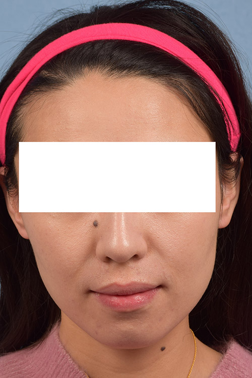 Hidden Patients Before & After Gallery - Patient 209797 - Image 1