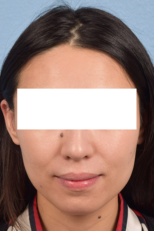 Hidden Patients Before & After Gallery - Patient 209797 - Image 2