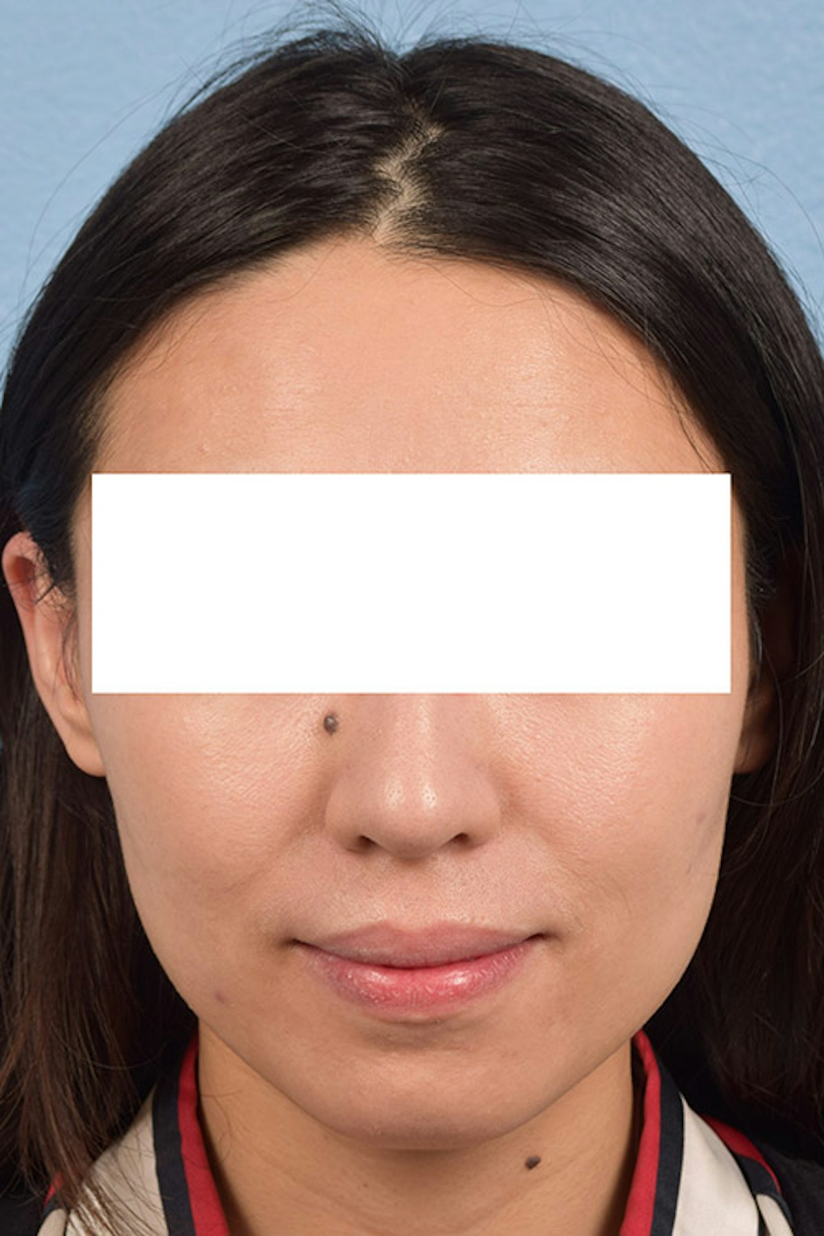 Facial Rejuvenation Before & After Gallery - Patient 379248 - Image 2