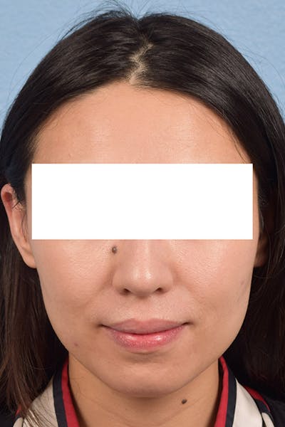 Facial Rejuvenation Before & After Gallery - Patient 379248 - Image 2
