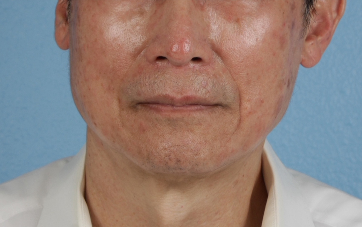 Pigment Laser Before & After Gallery - Patient 297186 - Image 1