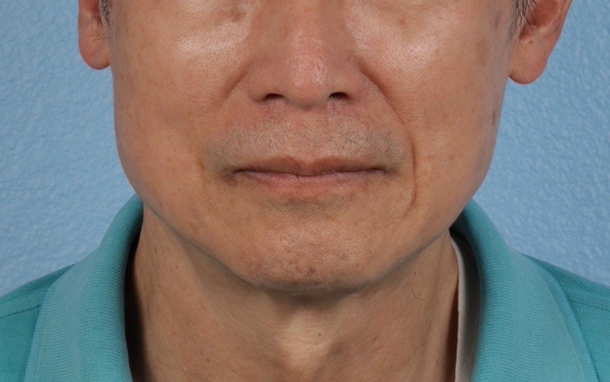 Pigment Laser Before & After Gallery - Patient 297186 - Image 2