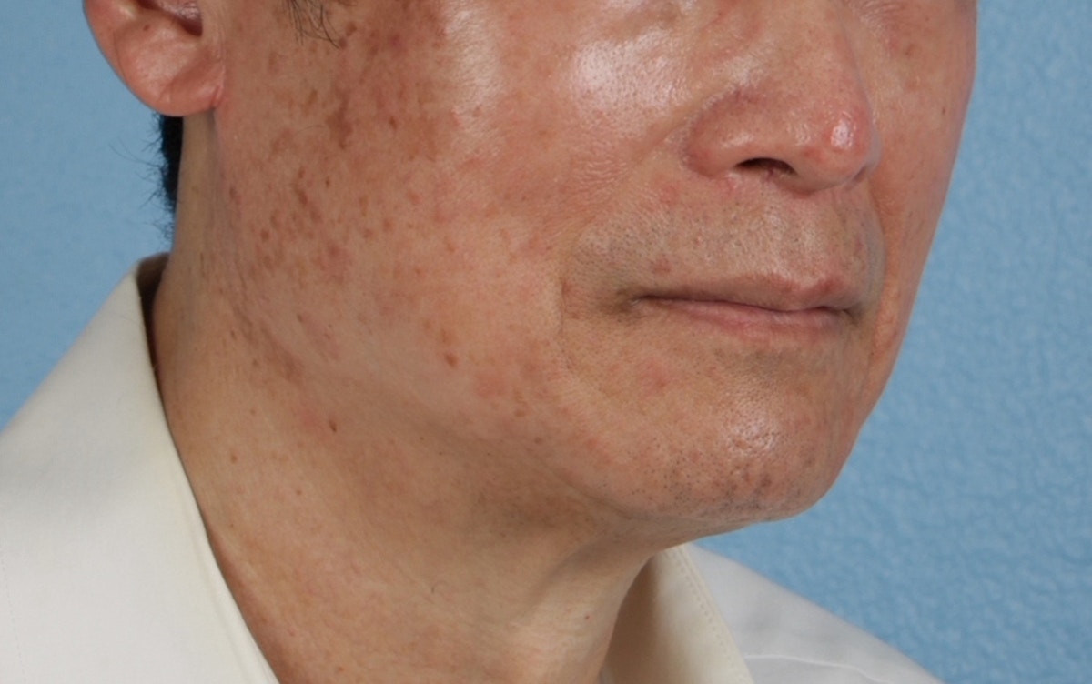 Pigment Laser Before & After Gallery - Patient 297186 - Image 3