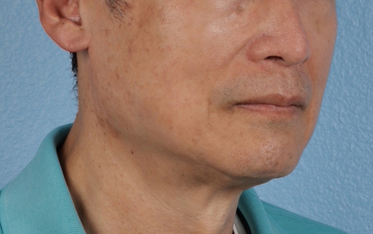 Pigment Laser Before & After Gallery - Patient 297186 - Image 4