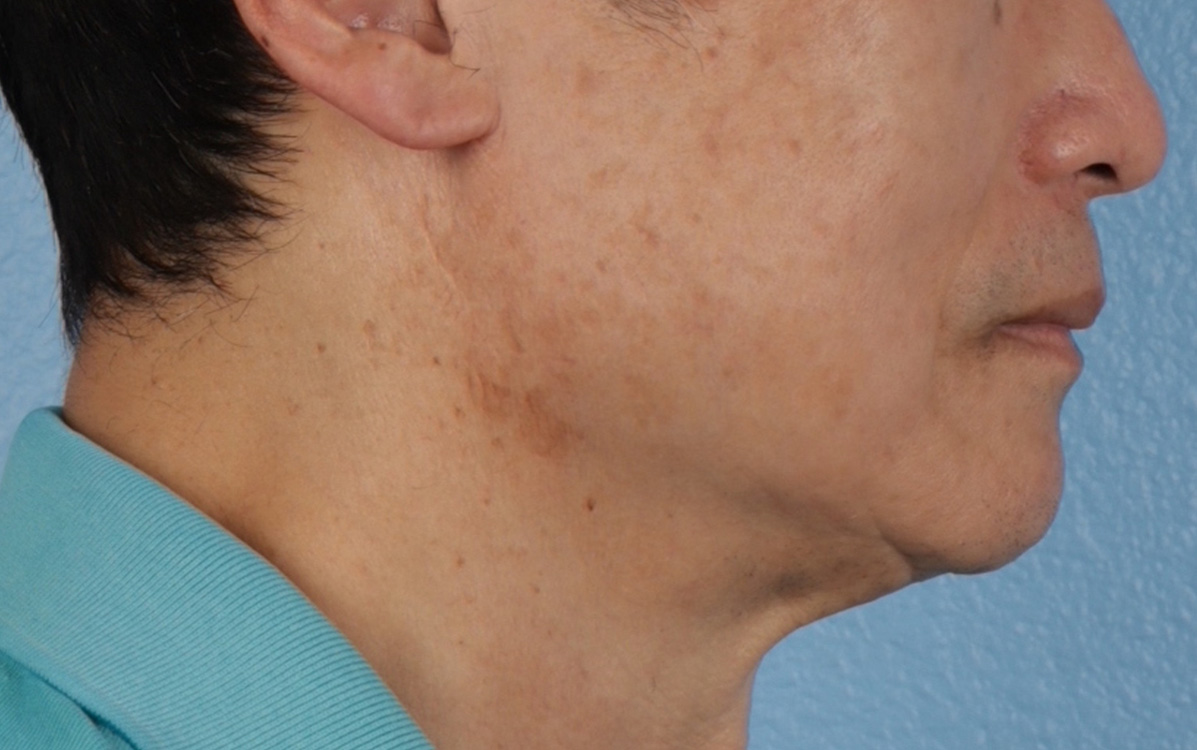 Pigment Laser Before & After Gallery - Patient 297186 - Image 4