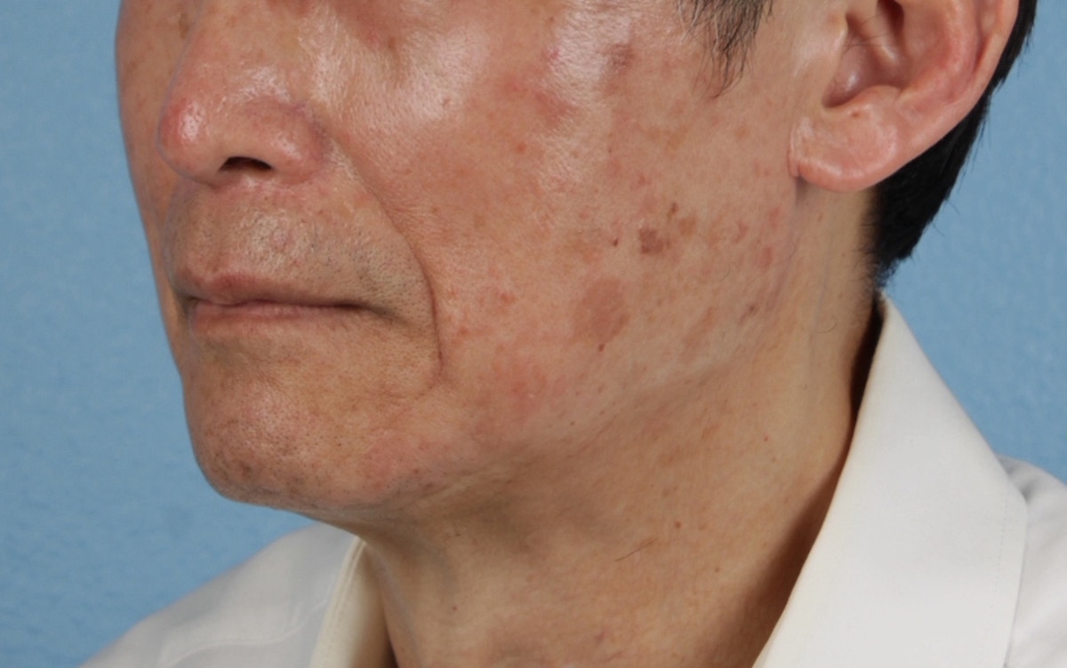 Pigment Laser Before & After Gallery - Patient 297186 - Image 7