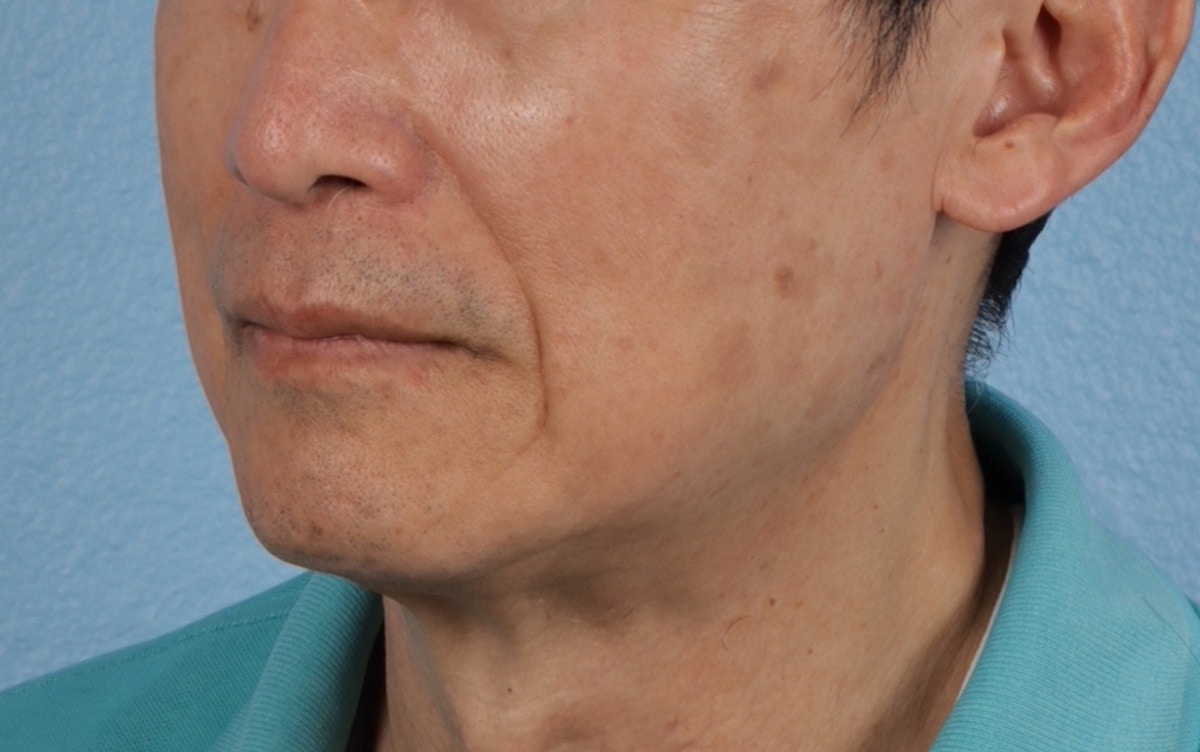 Pigment Laser Before & After Gallery - Patient 297186 - Image 8