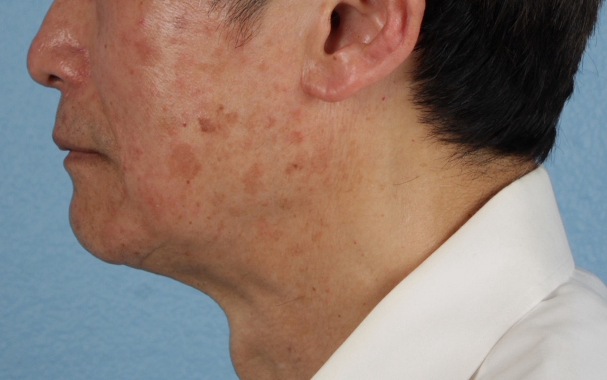 Pigment Laser Before & After Gallery - Patient 297186 - Image 9