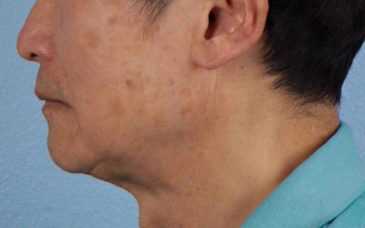 Pigment Laser Before & After Gallery - Patient 297186 - Image 10