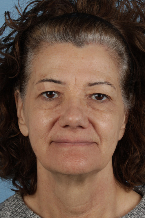 Pigment Laser Before & After Gallery - Patient 374844 - Image 1