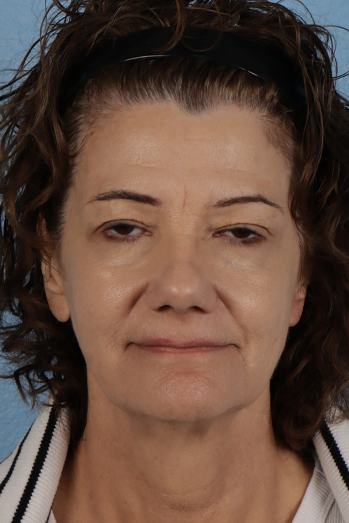 Pigment Laser Before & After Gallery - Patient 374844 - Image 2