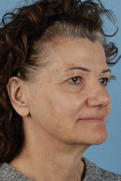 Pigment Laser Before & After Gallery - Patient 374844 - Image 3