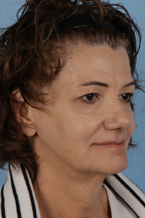 Pigment Laser Before & After Gallery - Patient 374844 - Image 4