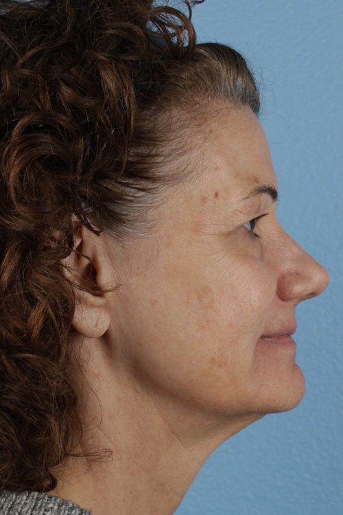 Pigment Laser Before & After Gallery - Patient 374844 - Image 5