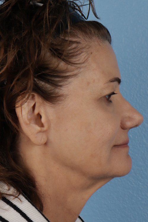 Pigment Laser Before & After Gallery - Patient 374844 - Image 6