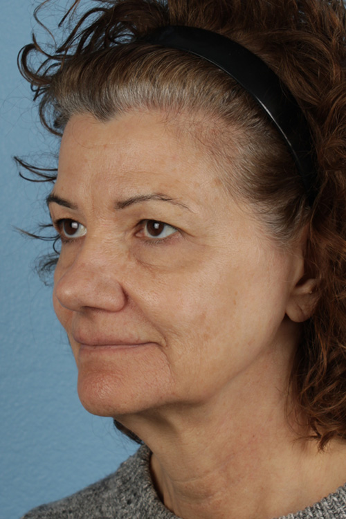 Pigment Laser Before & After Gallery - Patient 374844 - Image 7