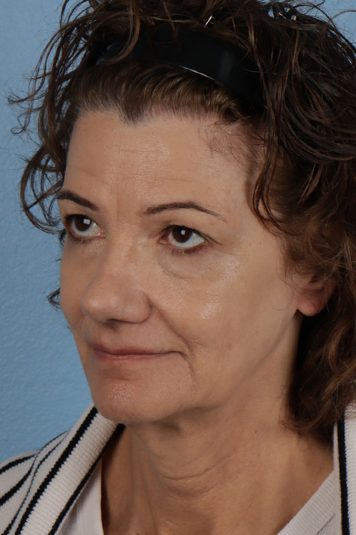 Pigment Laser Before & After Gallery - Patient 374844 - Image 8