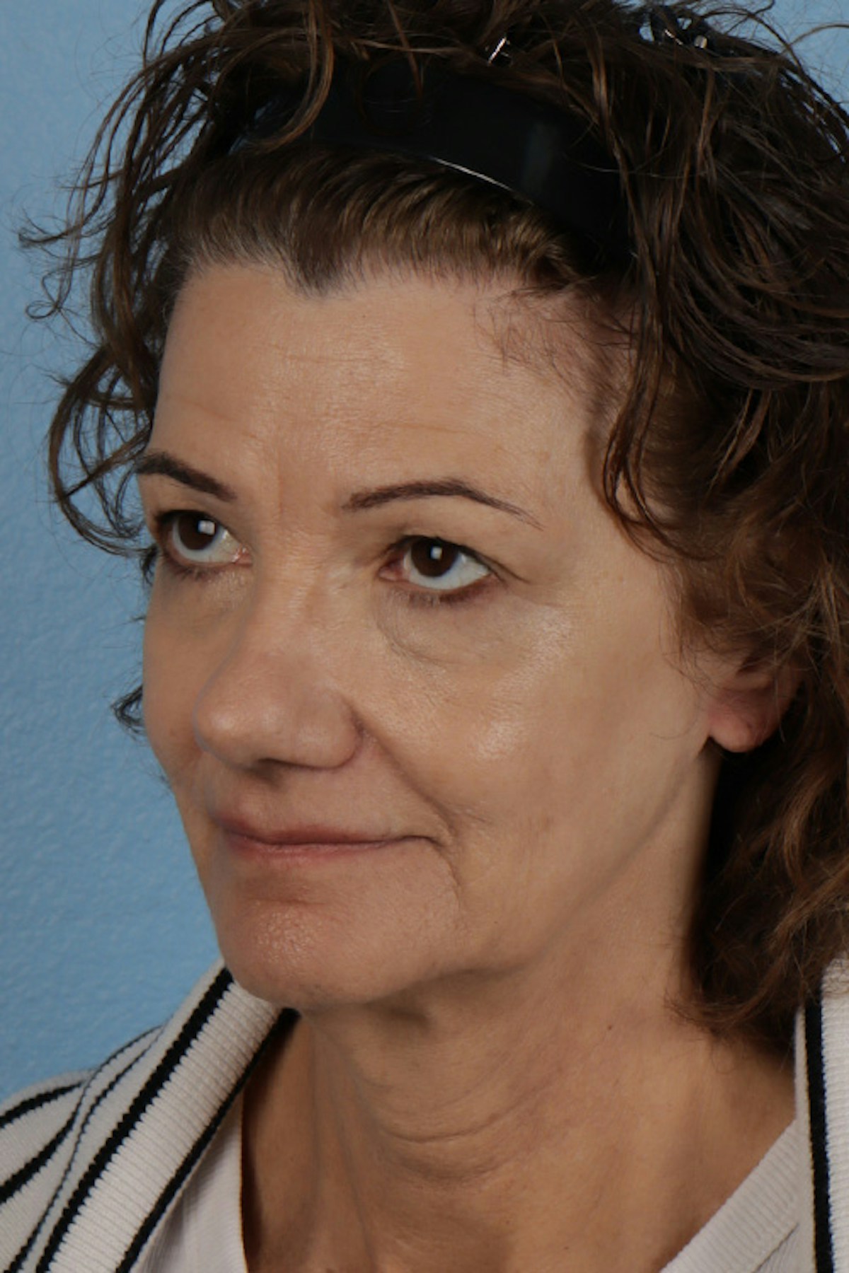 Pigment Laser Before & After Gallery - Patient 374844 - Image 8