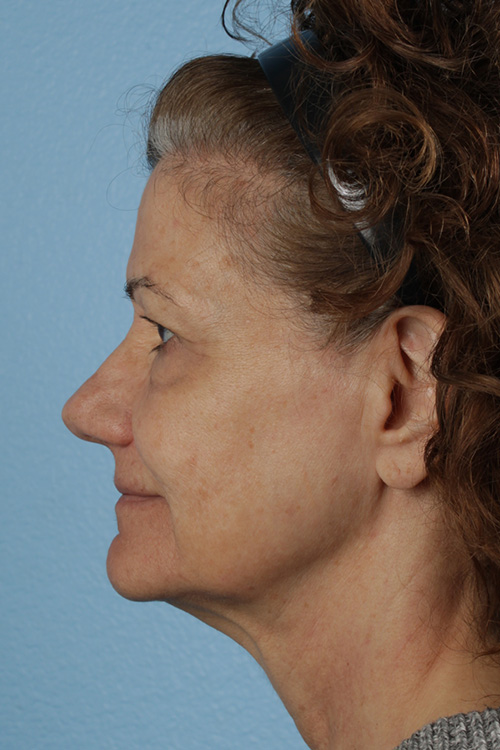 Pigment Laser Before & After Gallery - Patient 374844 - Image 9