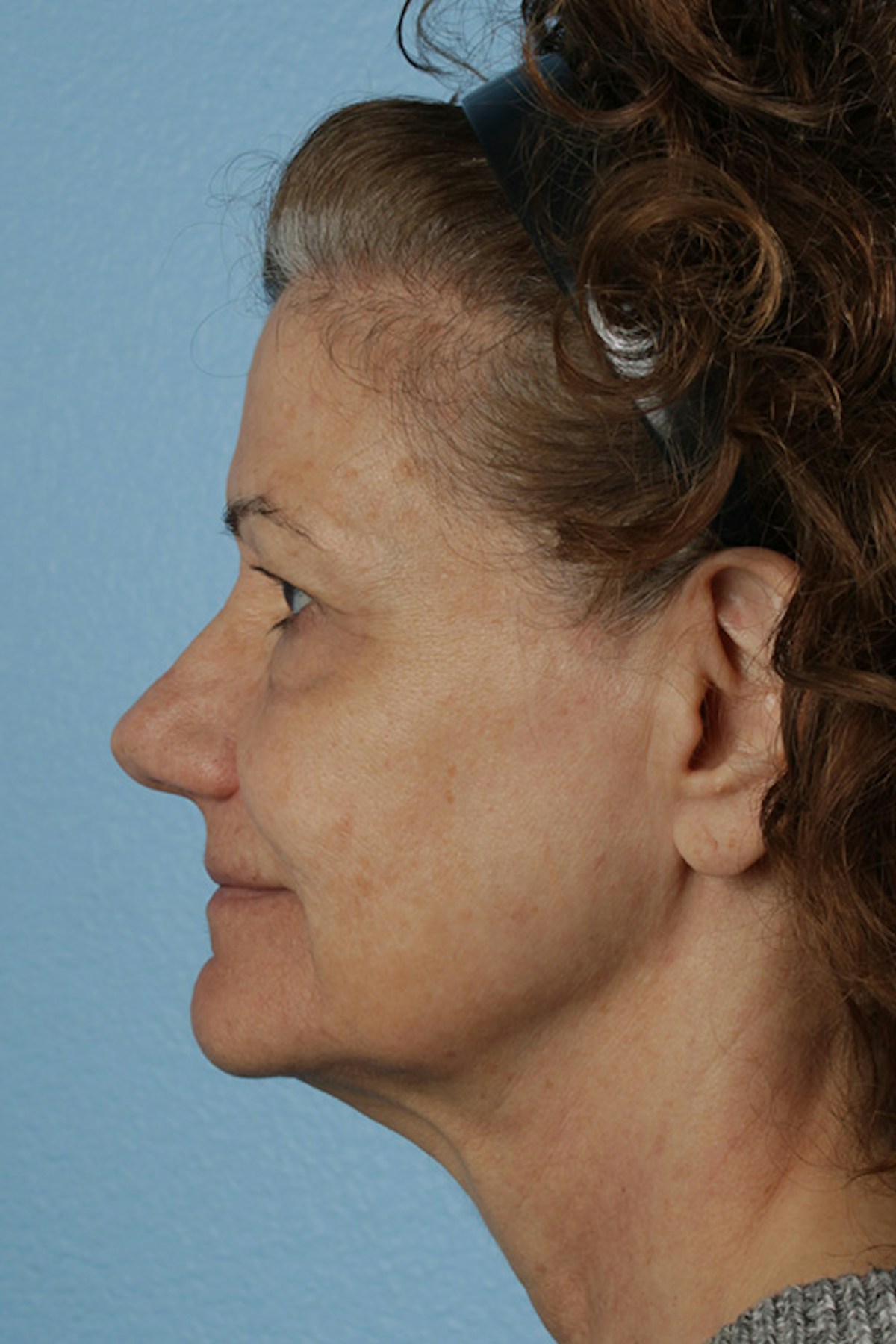 Pigment Laser Before & After Gallery - Patient 374844 - Image 9