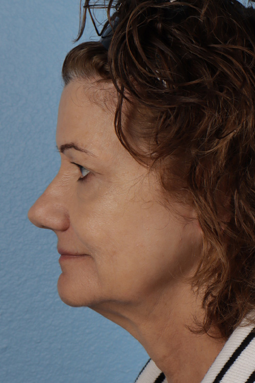 Pigment Laser Before & After Gallery - Patient 374844 - Image 10