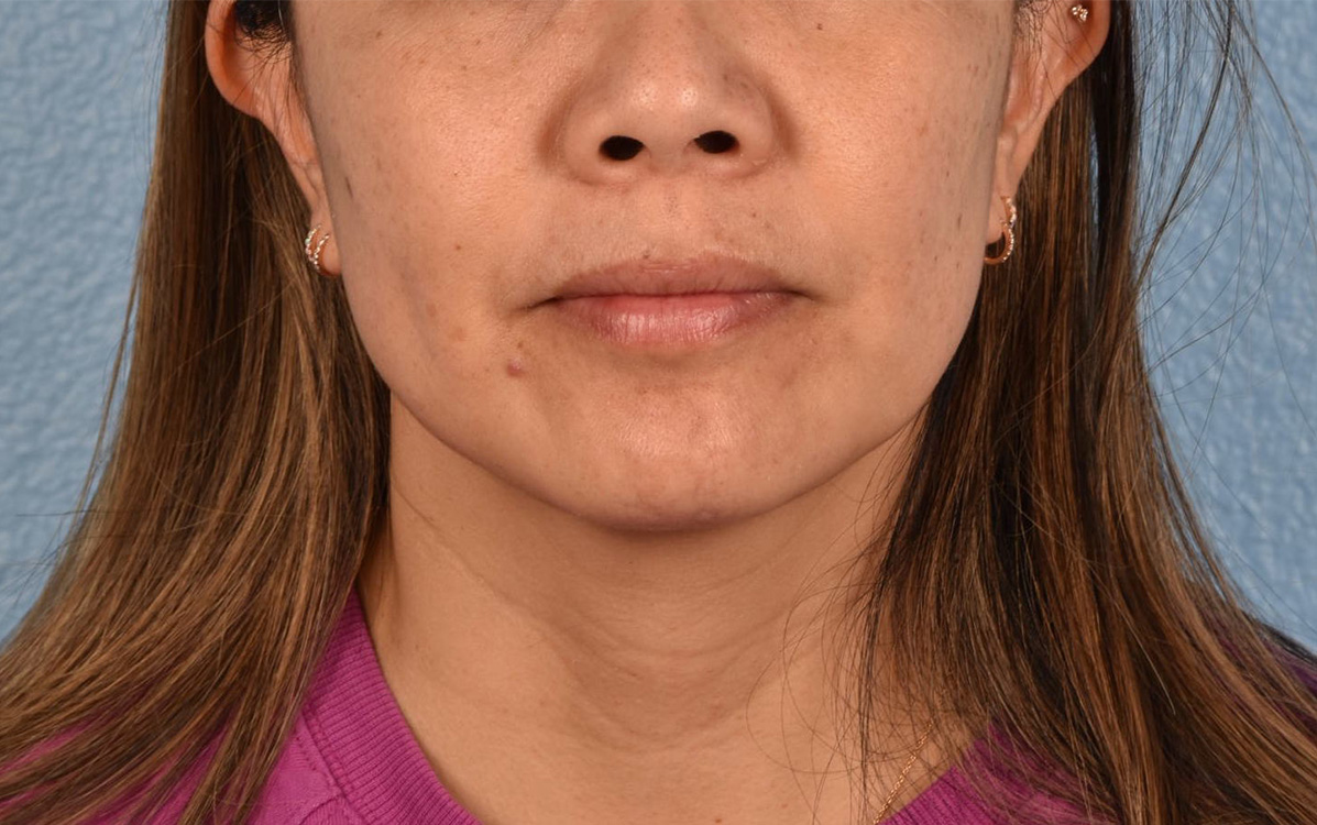 Hidden Patients Before & After Gallery - Patient 263878 - Image 1