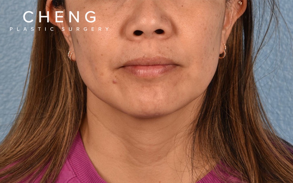 Hidden Patients Before & After Gallery - Patient 263878 - Image 1