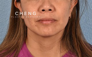 Hidden Patients Before & After Gallery - Patient 263878 - Image 1