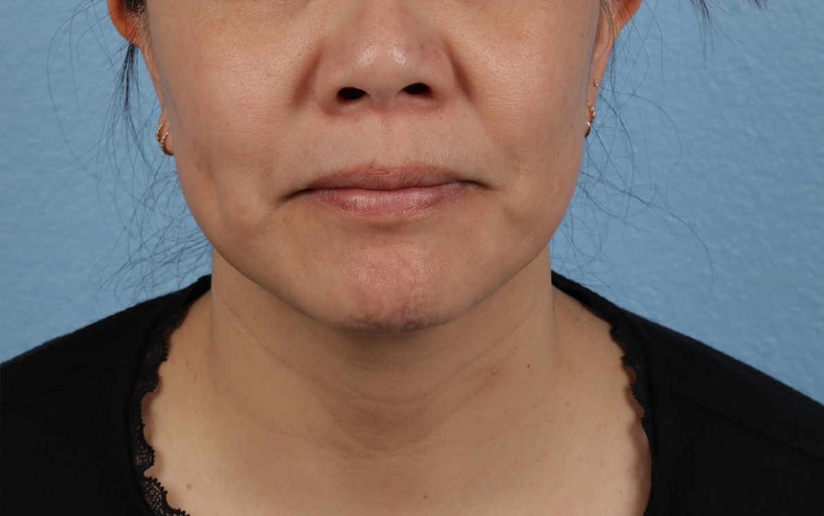 Hidden Patients Before & After Gallery - Patient 263878 - Image 2