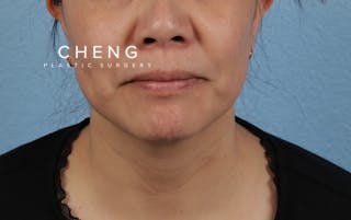 Hidden Patients Before & After Gallery - Patient 263878 - Image 2