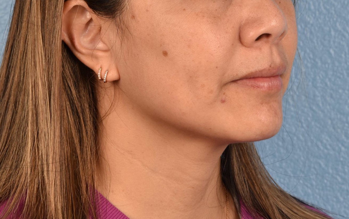 Pigment Laser Before & After Gallery - Patient 360523 - Image 3