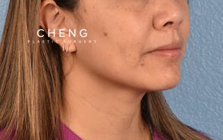 Hidden Patients Before & After Gallery - Patient 263878 - Image 3