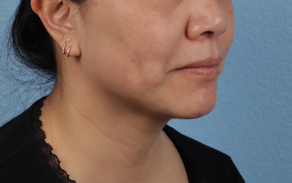 Pigment Laser Before & After Gallery - Patient 360523 - Image 4