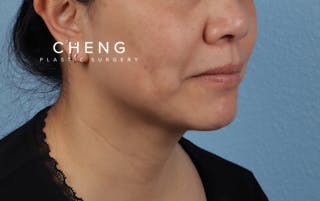 Hidden Patients Before & After Gallery - Patient 263878 - Image 4