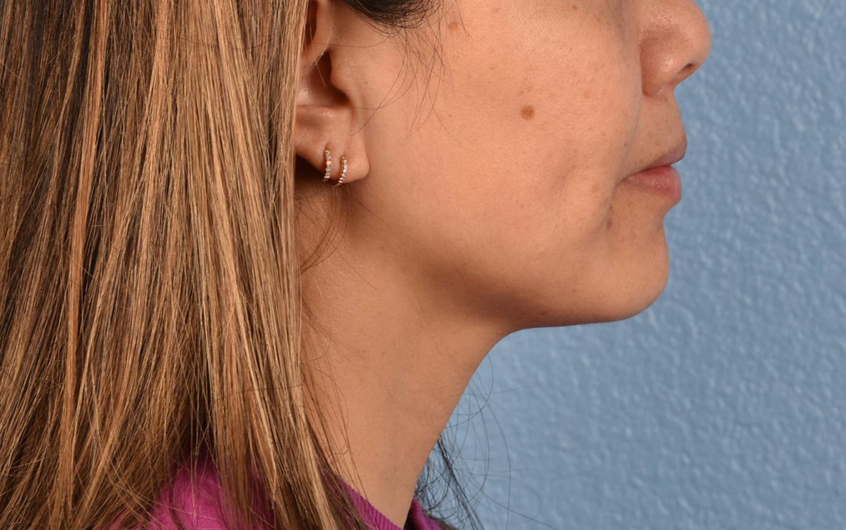 Hidden Patients Before & After Gallery - Patient 263878 - Image 5