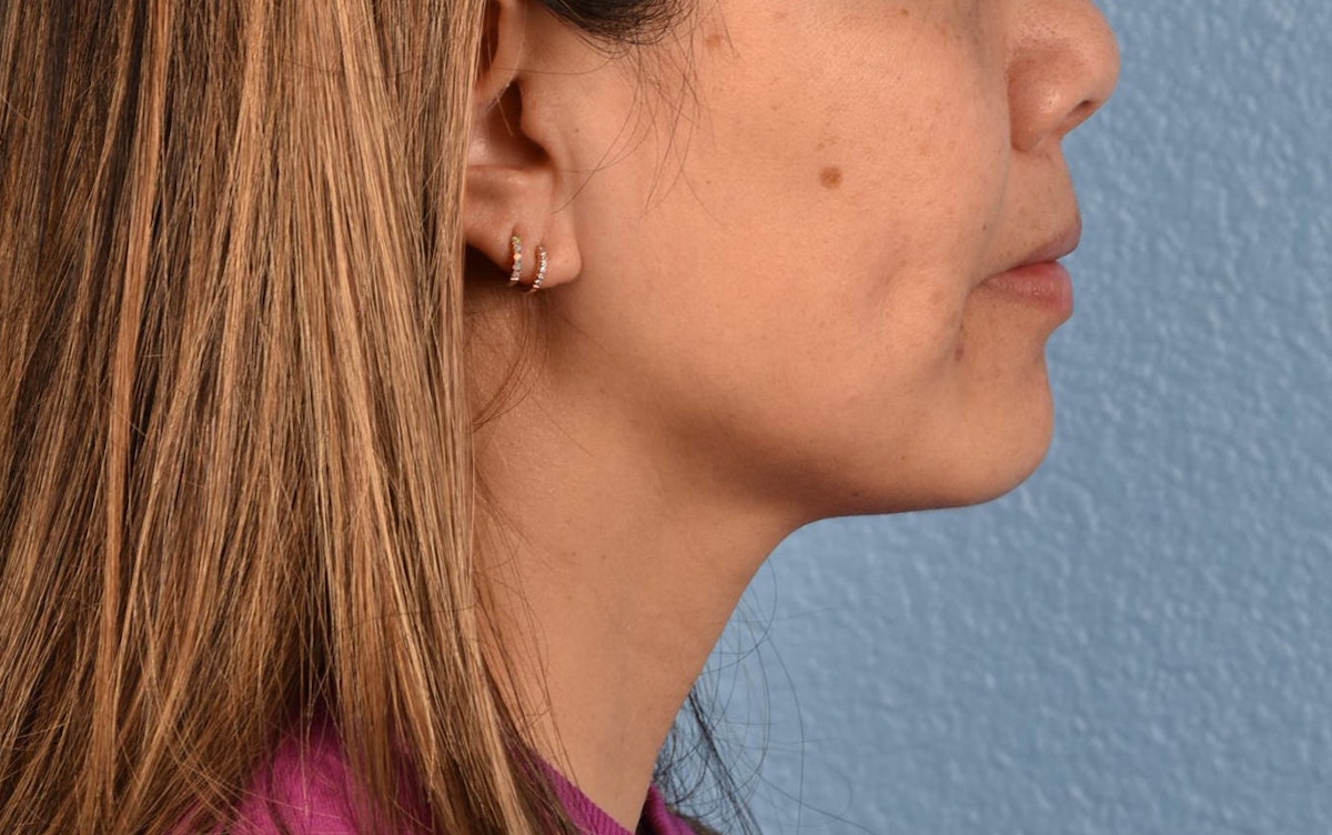 Pigment Laser Before & After Gallery - Patient 360523 - Image 5