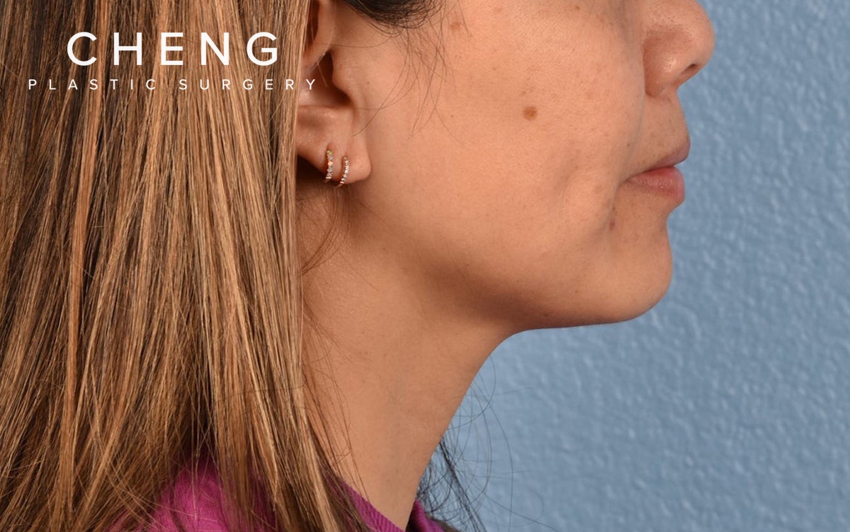 Hidden Patients Before & After Gallery - Patient 263878 - Image 5