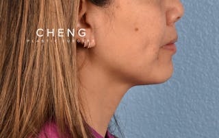 Hidden Patients Before & After Gallery - Patient 263878 - Image 5