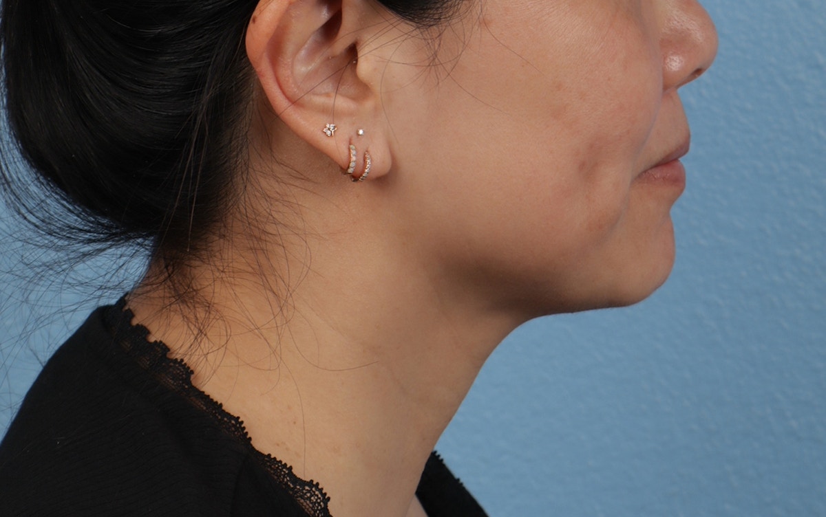 Pigment Laser Before & After Gallery - Patient 360523 - Image 6