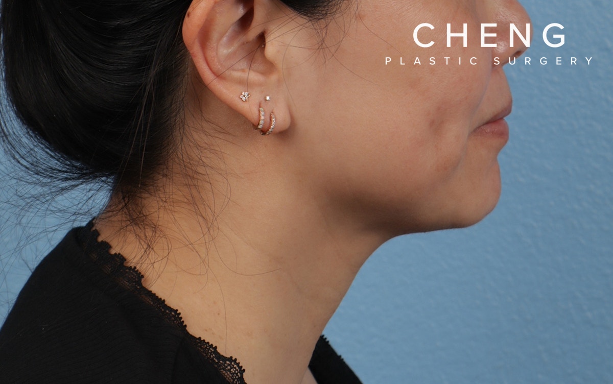 Hidden Patients Before & After Gallery - Patient 263878 - Image 6