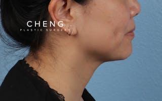 Hidden Patients Before & After Gallery - Patient 263878 - Image 6