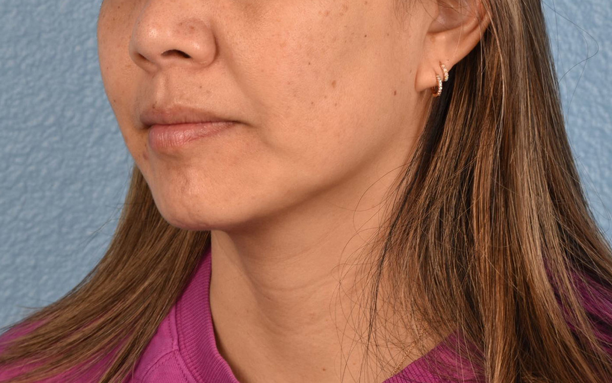 Hidden Patients Before & After Gallery - Patient 263878 - Image 7