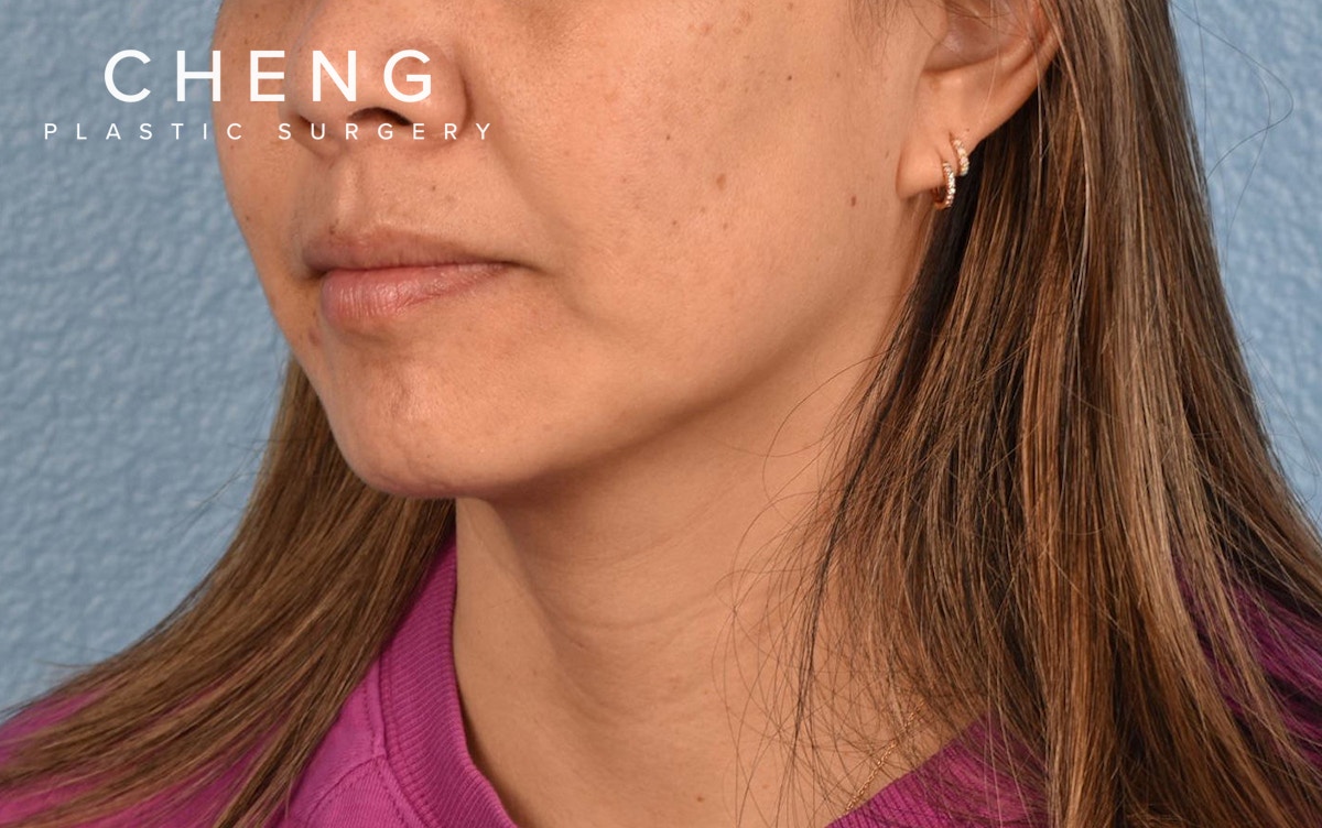 Hidden Patients Before & After Gallery - Patient 263878 - Image 7