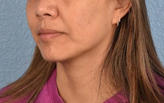 Hidden Patients Before & After Gallery - Patient 263878 - Image 7