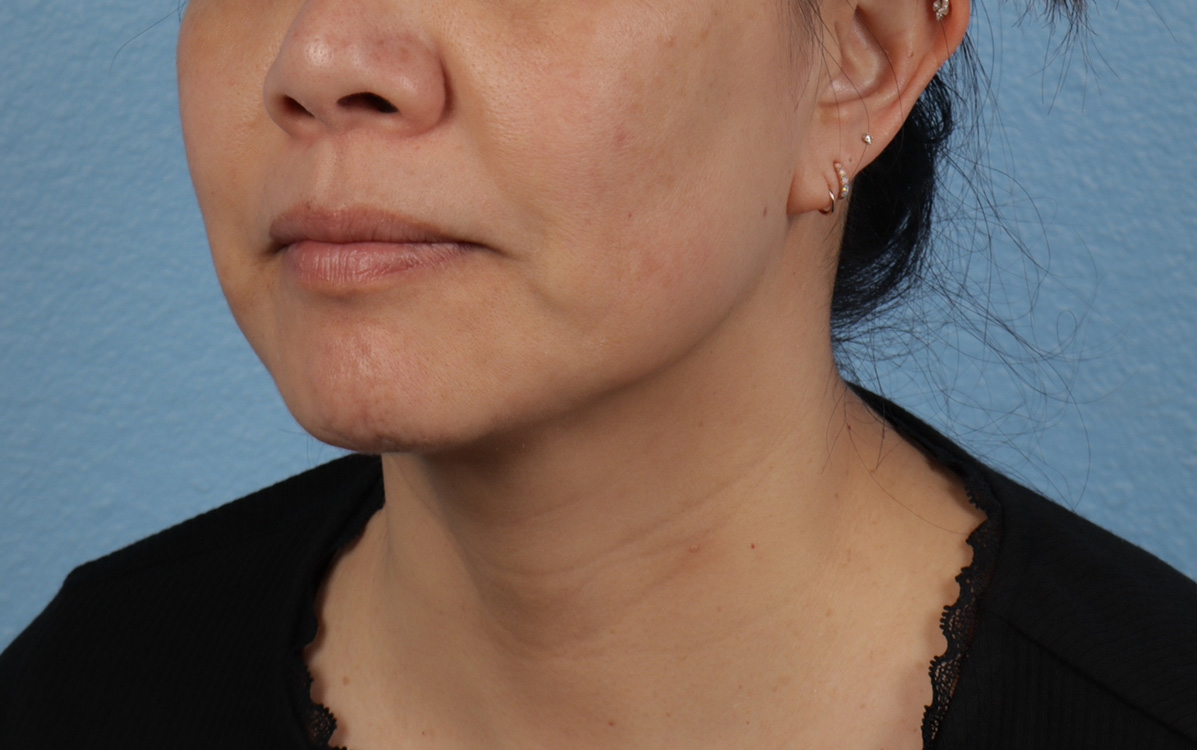 Hidden Patients Before & After Gallery - Patient 263878 - Image 8