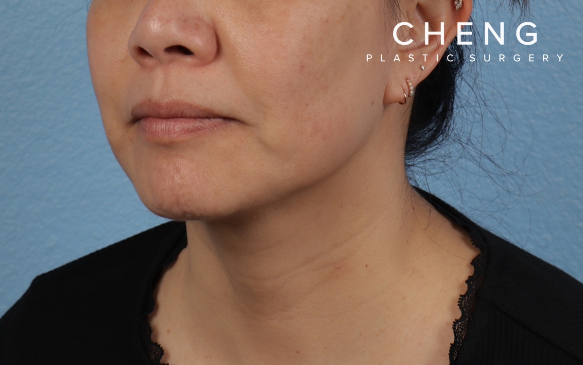 Hidden Patients Before & After Gallery - Patient 263878 - Image 8