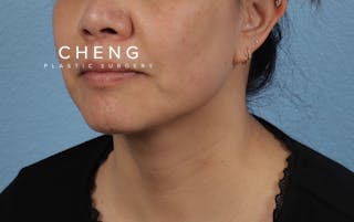 Hidden Patients Before & After Gallery - Patient 263878 - Image 8