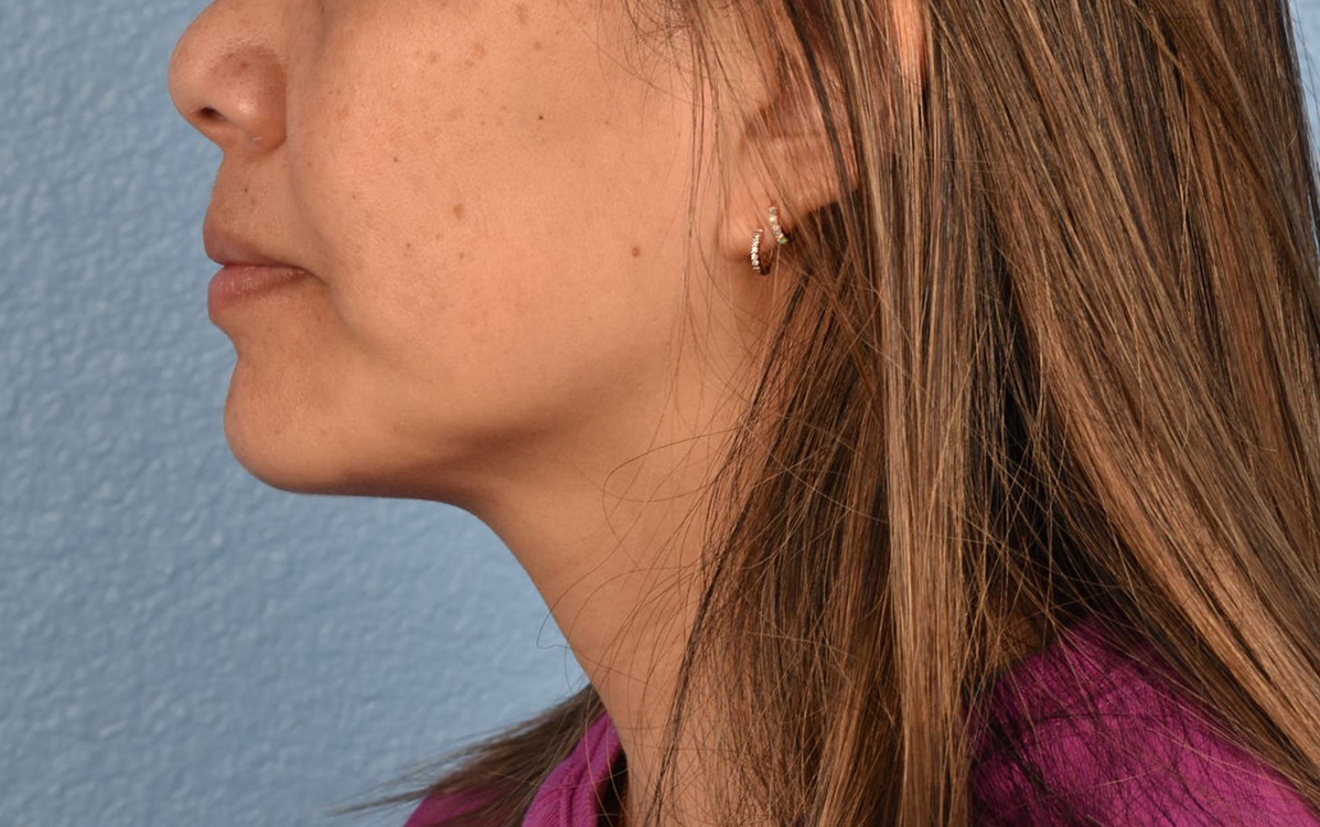 Hidden Patients Before & After Gallery - Patient 263878 - Image 9