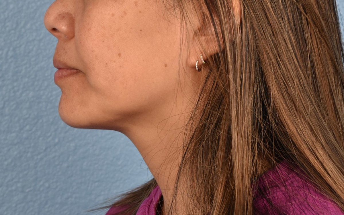 Pigment Laser Before & After Gallery - Patient 360523 - Image 9