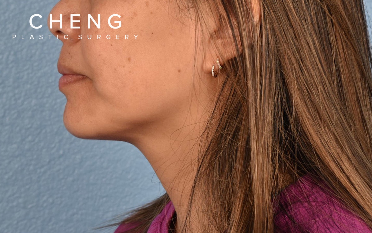 Hidden Patients Before & After Gallery - Patient 263878 - Image 9